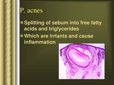 Ppt Disorders Of Sebaceous Glands Powerpoint Presentation Free Download Id694078