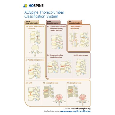 Ao Thoracolumbar Fracture Classification System Diagrams Image