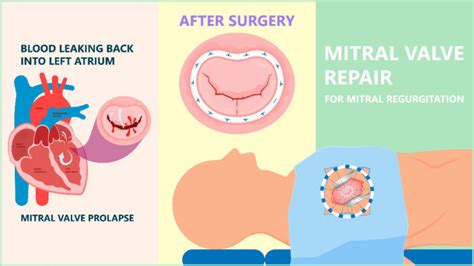 What Is Mitral Valve Disease Mitral Regurgitation Dr Raghu