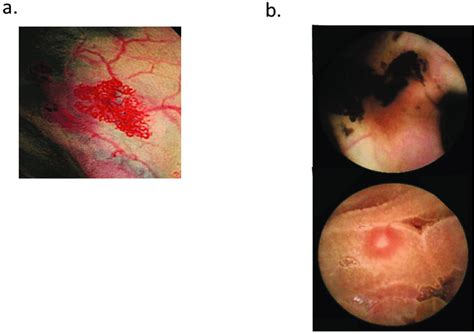 Angiodysplasia