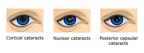 Types Of Cataracts And Symptoms Coastal Vision Center