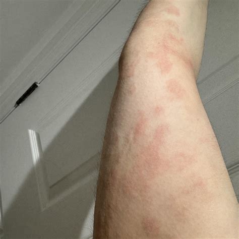 Is This Urticaria Or Eczema Rurticaria