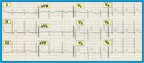 ECG Interpretation: ECG Interpretation Review #47 (Normal Variants ...