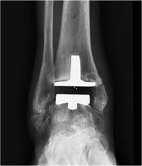 Outcomes Of Total Ankle Replacement With Preoperative Varus Deformity