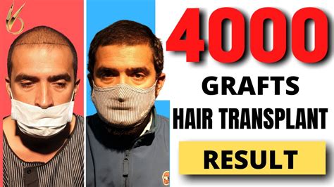 4000 Grafts Hair Transplant Result In India Grade 6 Baldness Darling Buds Clinic Youtube