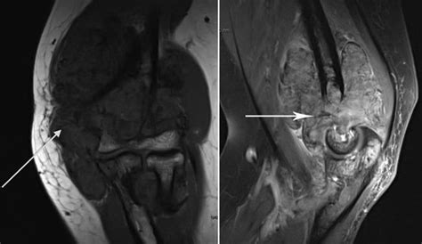 PVNS knee | Joint fluid, Magnetic resonance imaging, Things under a ...