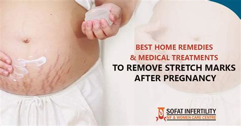 How To Remove Stretch Marks After Pregnancy At Home Pregnancywalls