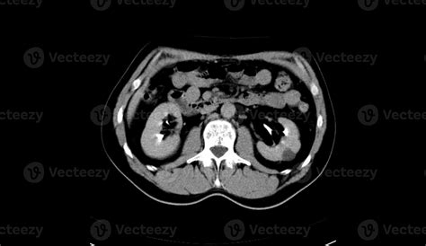 Abdomen human, man, CT scan 12871211 Stock Photo at Vecteezy