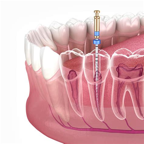 Root Canal Treatment – sinanak.com