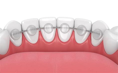 La Importancia De Los Retenedores De Ortodoncia Arce Dental