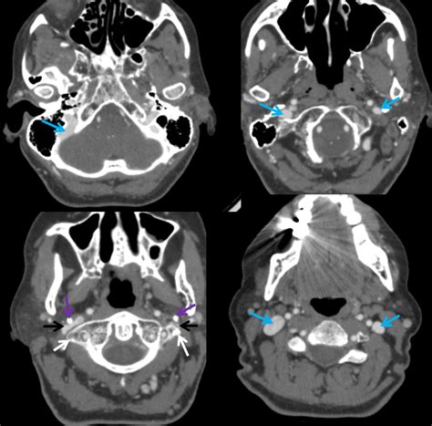 Differential Diagnosis: Pulsatile Tinnitus Differential Diagnosis