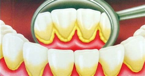 O que é causas e como evitar o tártaro nos dentes