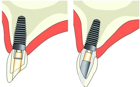 Screw Retained Anterior Implant Crown