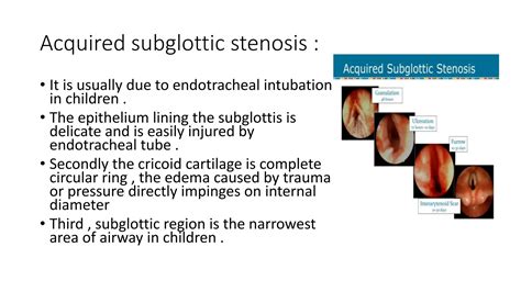 SUBGLOTTIC STENOSIS Pptx