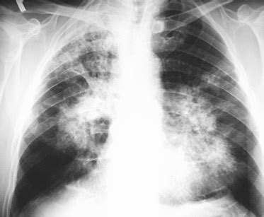 Tuberculosis chest x ray - wikidoc