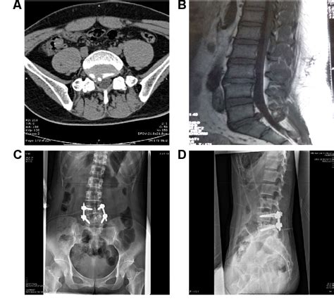 Figure 1 From Comparison Of Outcomes Between Minimally Invasive Transforaminal Lumbar Interbody