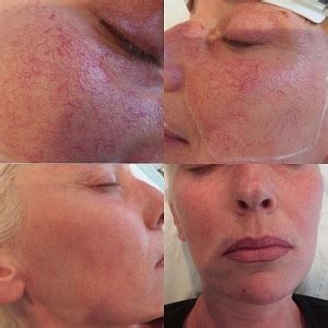 Facial Thread Vein Treatment Telegraph