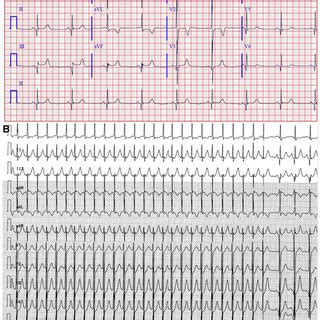 A Baseline Electrocardiogram Showing Sinus Bradycardia At 56 Beats Per