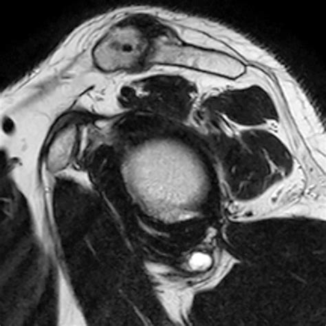 Shoulder Cysts Radsource