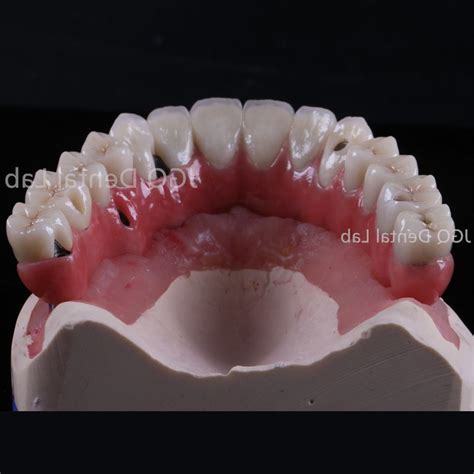 Customized Full Contour Zirconia Implant Bridge All On 6 Full Arch