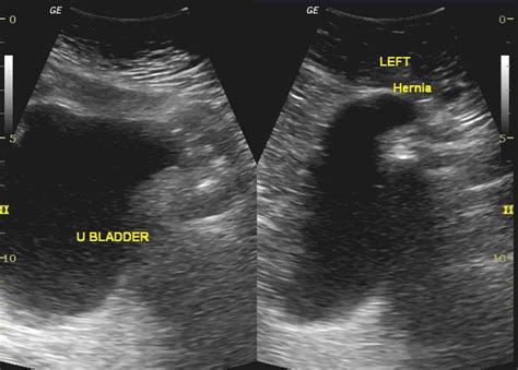 Radiopaedia Case Urinary Bladder Hernia Id 26649 Study 26796 NC Commons