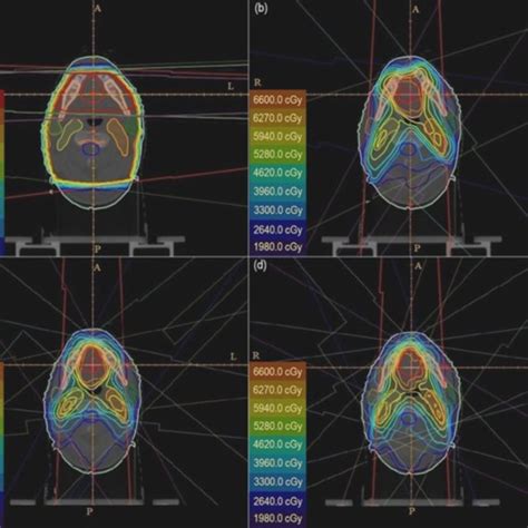 Differences In Dose Distribution For A D Crt B Imrt F C