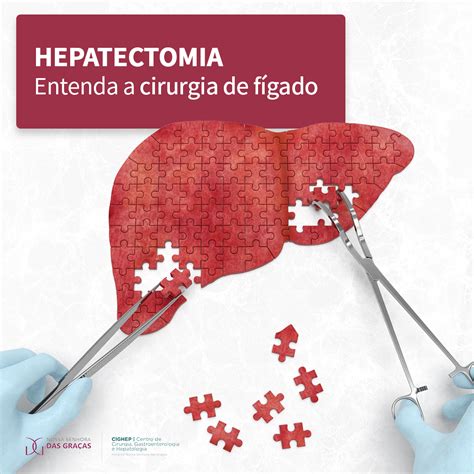 Hepatectomia Entenda a cirurgia de fígado Cighep