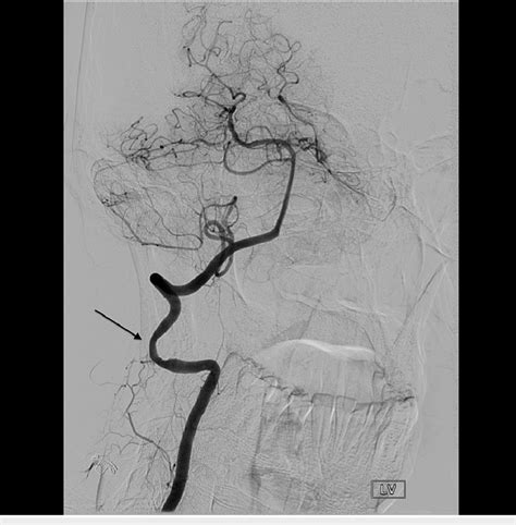 Cerebral Angiogram With The Head Rotated To The Right Shows The Dynamic