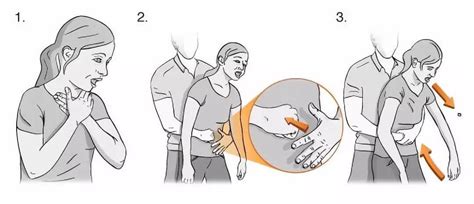 heimlich maneuver     ceotudent