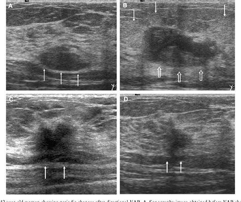 Figure From Sonographic Changes After Removing All Benign Breast