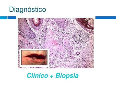 Carcinoma Espinocelular