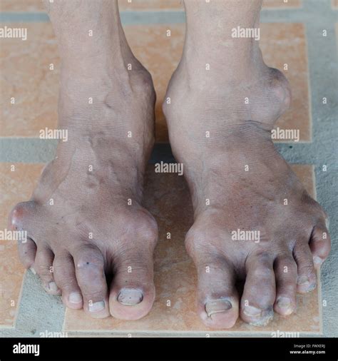 Gout foot hi-res stock photography and images - Alamy