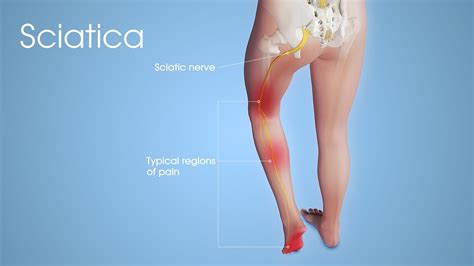 Exercise Sciatica Treatment Sciatica Treatment Sciatica Treatment