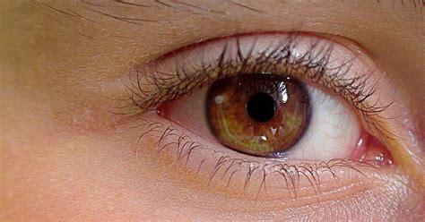 Lidrandentz Ndung Symptome Und Hausmittel Bei Blepharitis