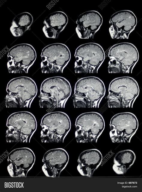 MRI Brain Sagittal MS1 Stock Photo & Stock Images | Bigstock