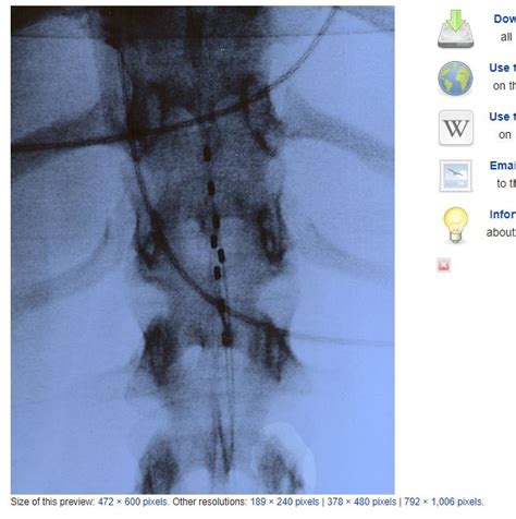 Epidural Stimulation Spinalpedia