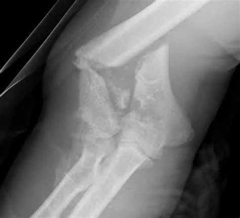 distal humerus replacement | The Bone School