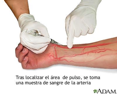 Medlineplus Enciclopedia M Dica Muestra De Sangre Arterial