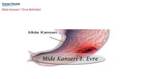 1 2 3 4 Mide Kanseri Evreleri Ve Yaşam Süreleri