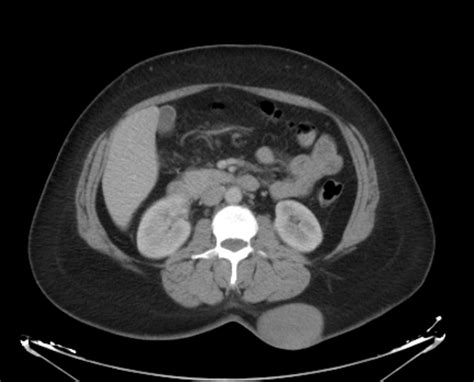 Dermatofibrosarcoma protuberans | Radiology Reference Article ...