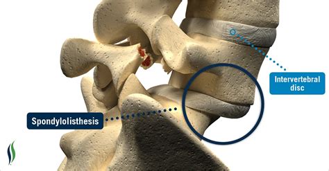 Spondylolisthesis | Spondylolysis | Grades, Causes, Signs & Treatment