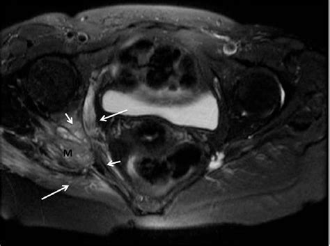 Deep Gluteal Syndrome: anatomy, imaging and management of the sciatic ...