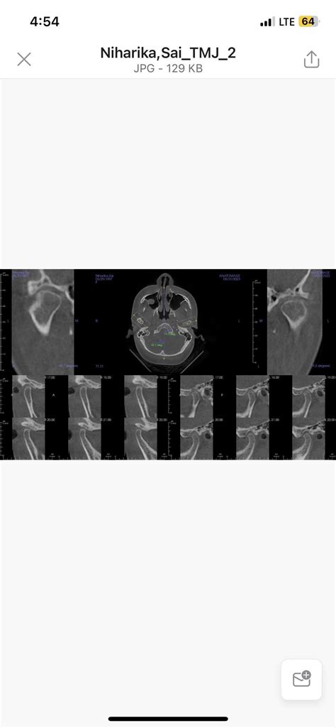 CBCT REPORT INTERPRETATION NEEDED ASAP : r/TMJ