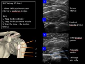 Where to start with Musculoskeletal Ultrasound? 5 #TopTips! - BJSM blog ...