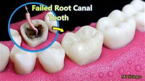 Incredible Reconstruction Of Poor Failed Root Canal Treated Tooth