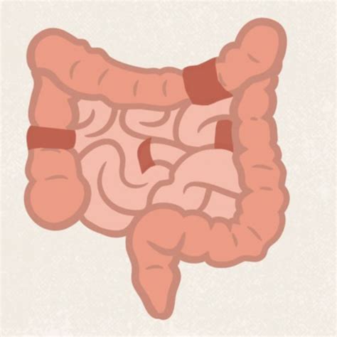 Pharm Constipation Diarrhea Ibs Ibd Flashcards Quizlet