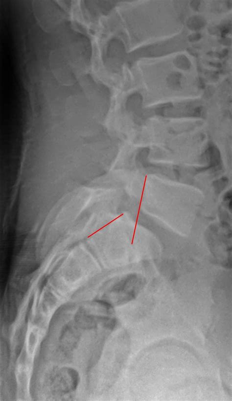 Spondylolisthesis Prince Chiropractic Wellness Center