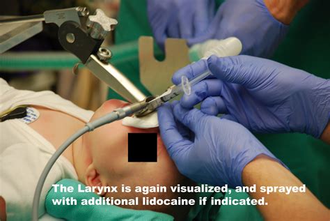 Indications Of Laryngoscopy At Jeffrey Mcguire Blog