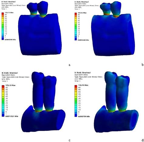 Figure 1 From Comparison Of Implants Placed In Mandible And