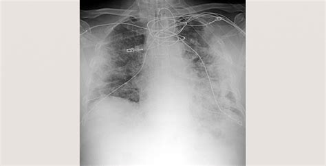 Elsevier Covid-19 Healthcare Hub | RADIOLOGY, from Chest Team COVID-19